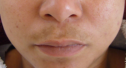 lading aardolie dodelijk Pigmentvlekken - Vitiligo dit zijn witte vlekken in de huid - Pure  Beautycare